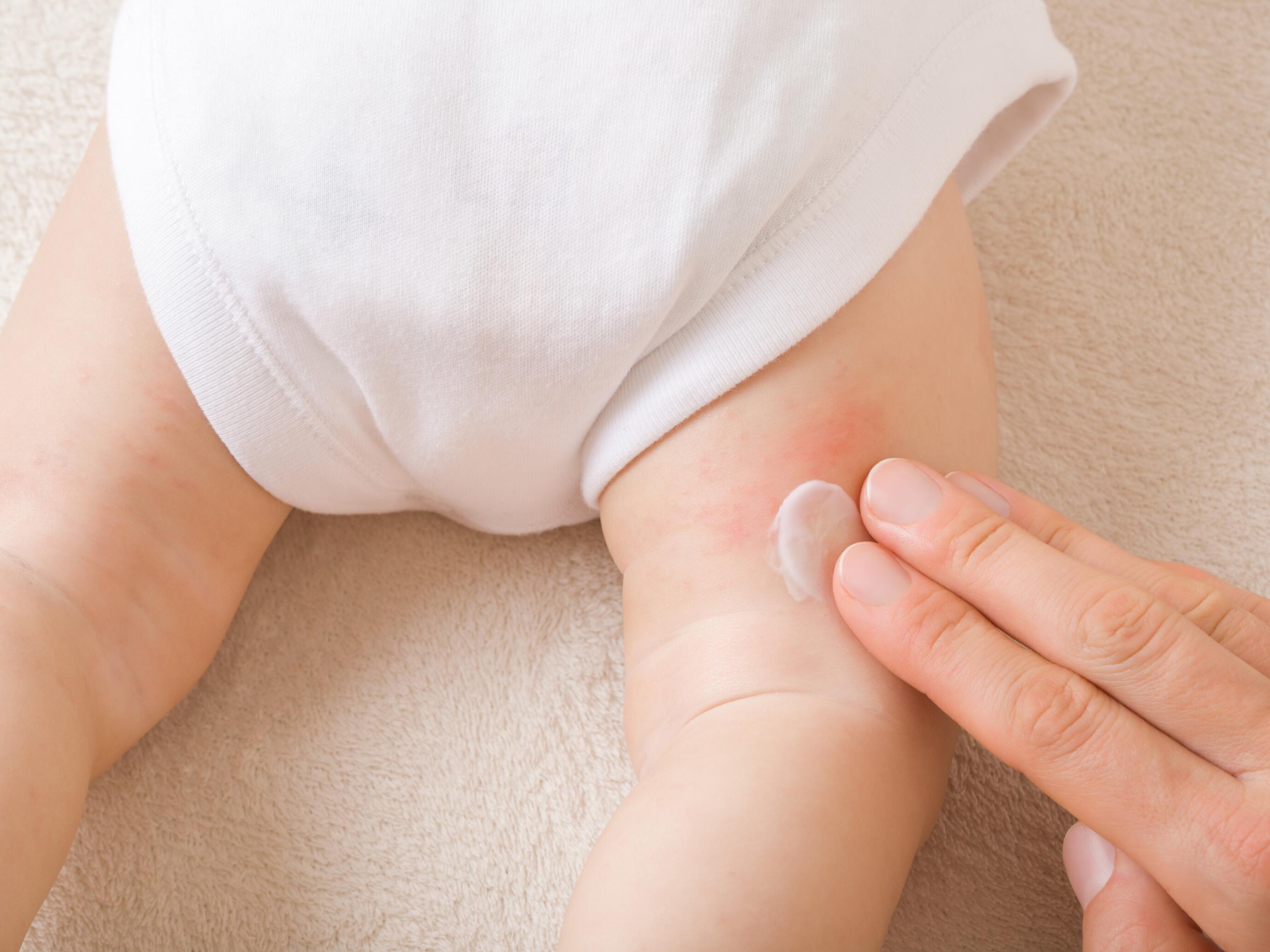 crema para eritema en las nalgas del bebé